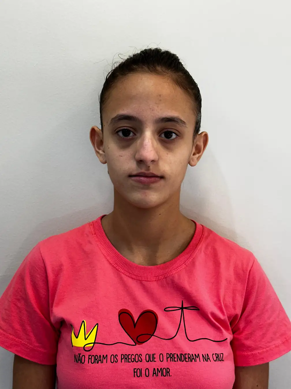 Orelhas de abano severas antes do tratamento - Caso de otomodelação sem cirurgia realizado pela Alexia Clinic