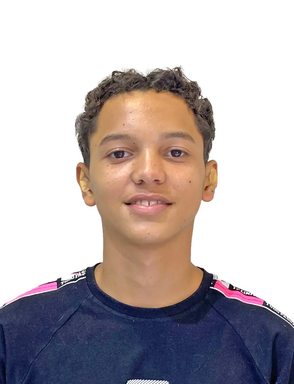 Resultado da otomodelação com Método EarLine - Orelhas harmonizadas sem cirurgia, resultado natural e definitivo