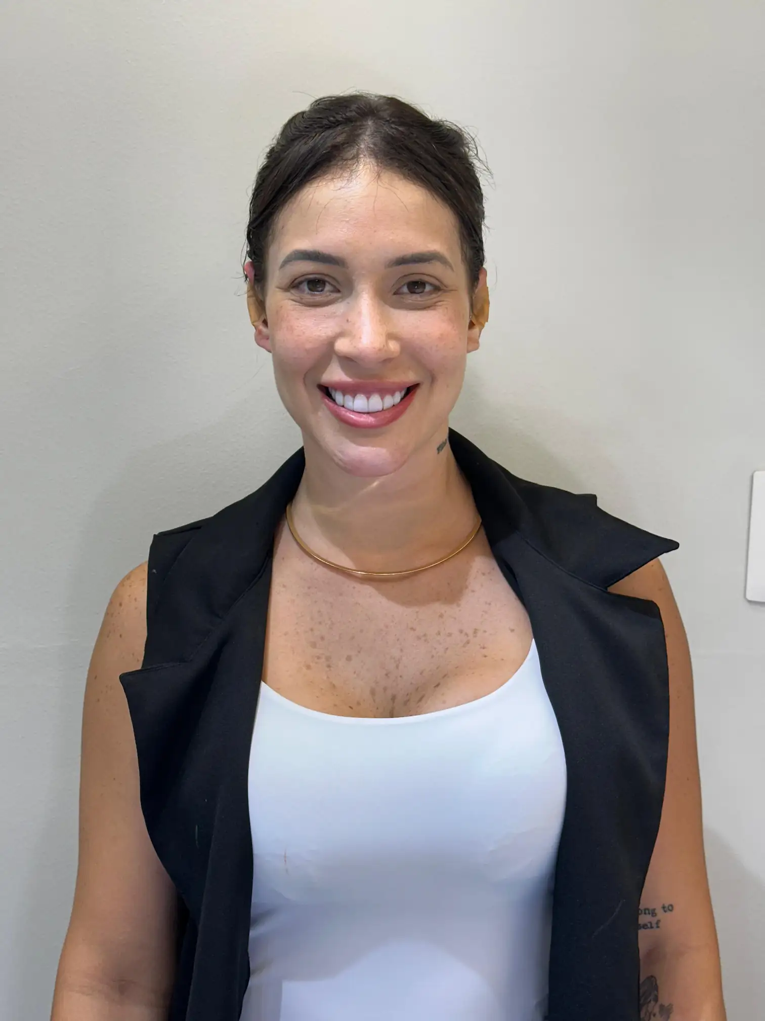 Pós-procedimento Método EarLine - Orelhas harmônicas após otomodelação, recuperação rápida e resultado permanente